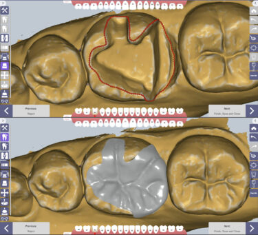 ネット注文でAIデザインからミリングまでスムーズに　歯科補綴物AIデザインソフト「FinalTouch(TM)」日本でのインレーデザイン受注開始